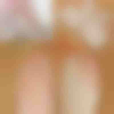 Corretor ortopédico de joanetes FIXEDFEET (1 par: esquerdo e direito)